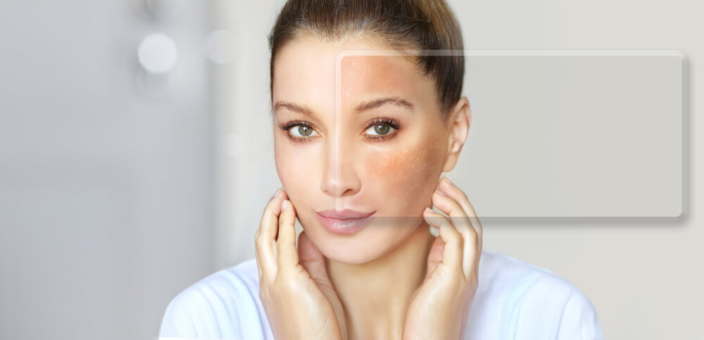 woman with hyperpigmentation