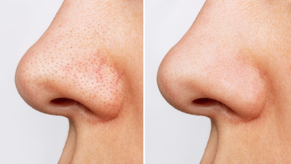 close up pores on nose